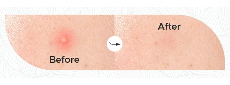 The Right Choice | Parches Hidrocoloides Para Acné